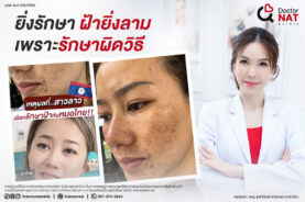 รักษาฝ้าผิดวิธียิ่งรักษา ฝ้ายิ่งลาม