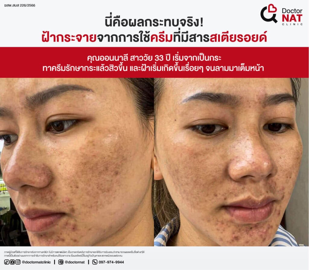 รักษาฝ้าผิดวิธี ยิ่งรักษา ฝ้ายิ่งลาม