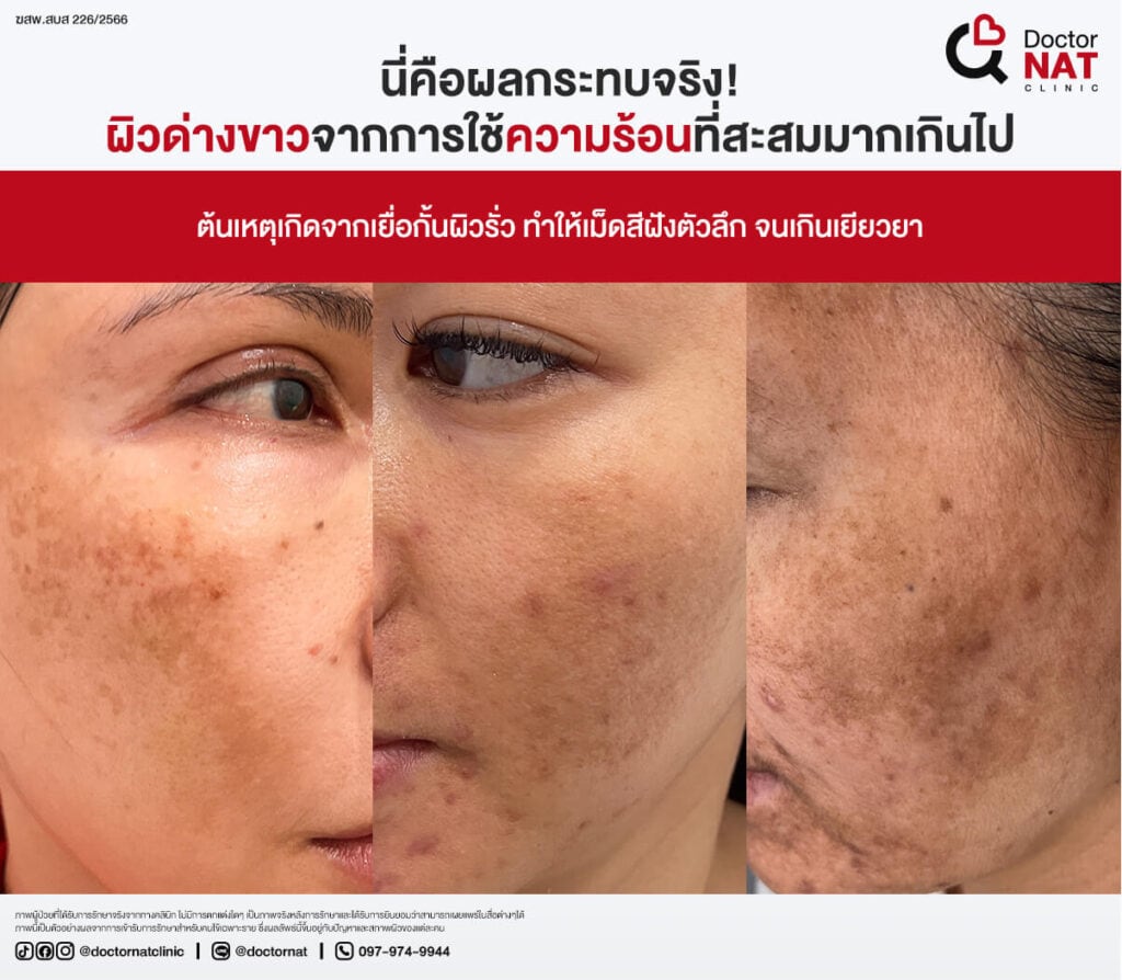 รักษาฝ้าผิดวิธี ยิ่งรักษา ฝ้ายิ่งลาม