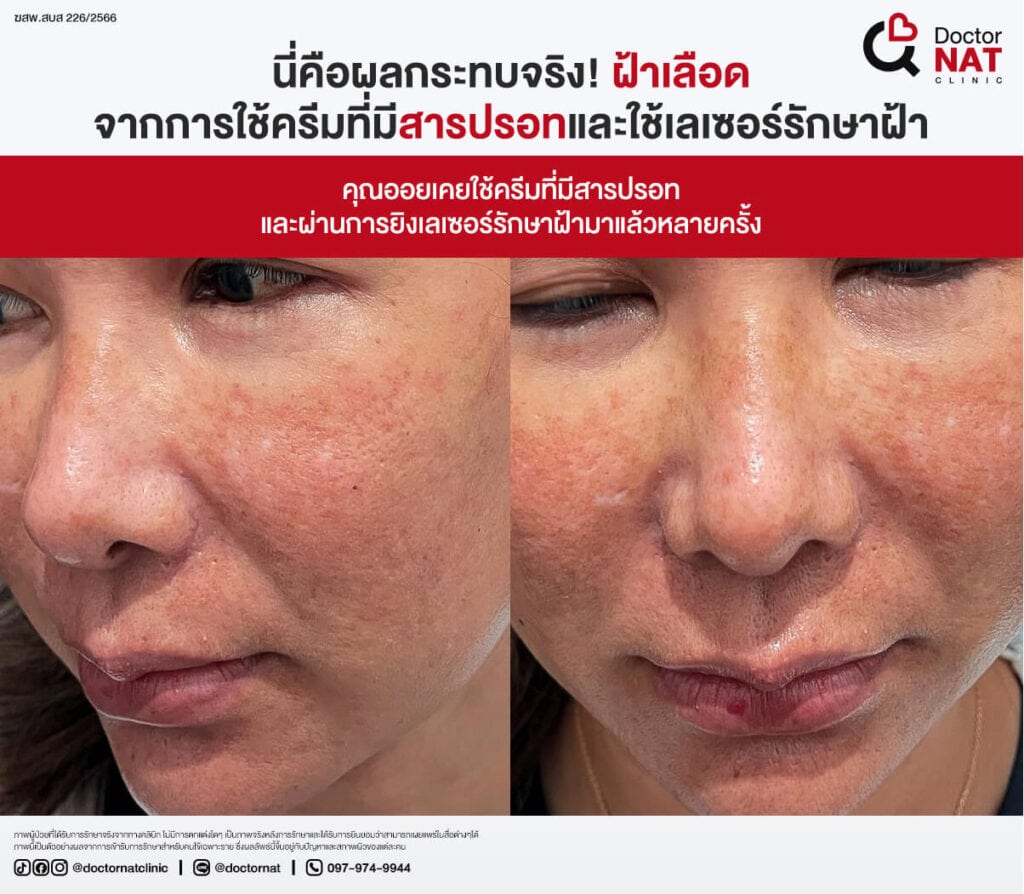 รักษาฝ้าผิดวิธี ยิ่งรักษา ฝ้ายิ่งลาม