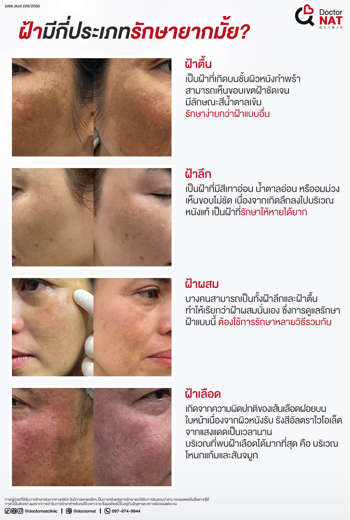 ฝ้ามีกี่ประเภท