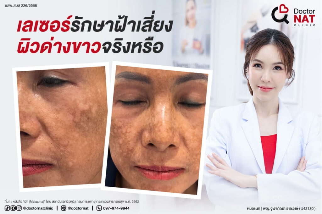 ผลข้างเคียงจากการรักษาฝ้าด้วยเลเซอร์