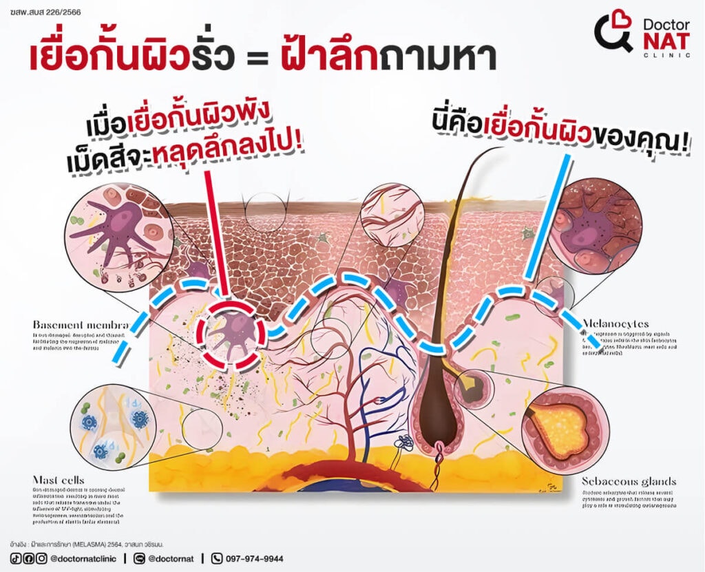 หยุดใช้ความร้อนที่สะสมมากเกินไปในการรักษาฝ้า