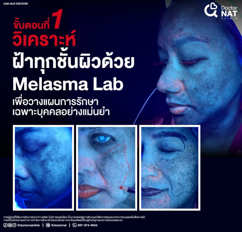 ขั้นตอนที่ 1 
วิเคราะห์ปัญหาฝ้าทุกชนิด ทุกชั้นผิวด้วย
Melasma Lab เพื่อวางแผนการรักษาเฉพาะบุคคล