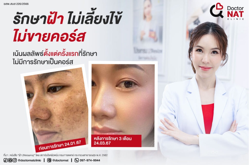 ทำไมต้องรักษาฝ้าที่ Doctor NAT Clinic