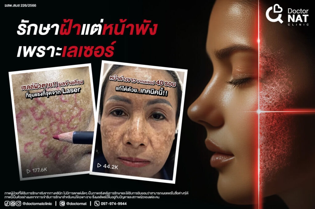 รักษาฝ้าแต่หน้าพัง เพราะเลเซอร์