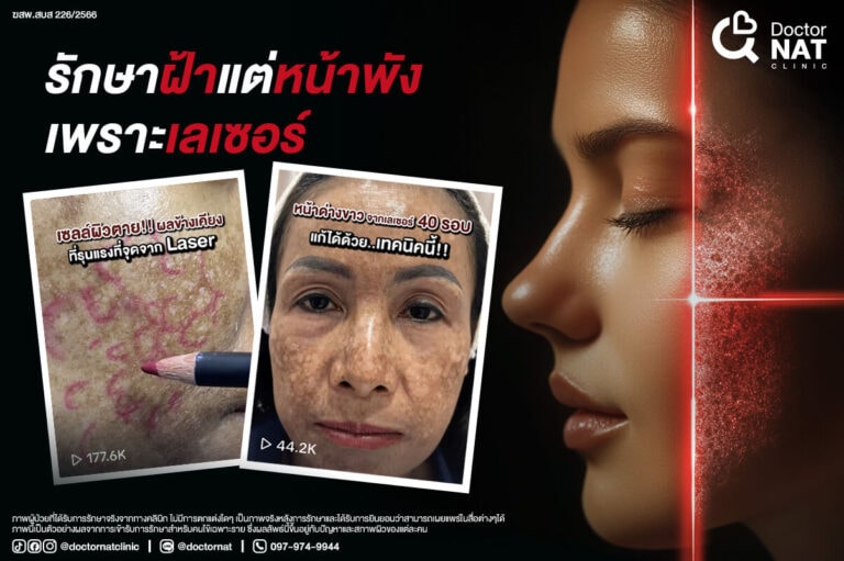 รักษาฝ้าแต่หน้าพัง เพราะเลเซอร์