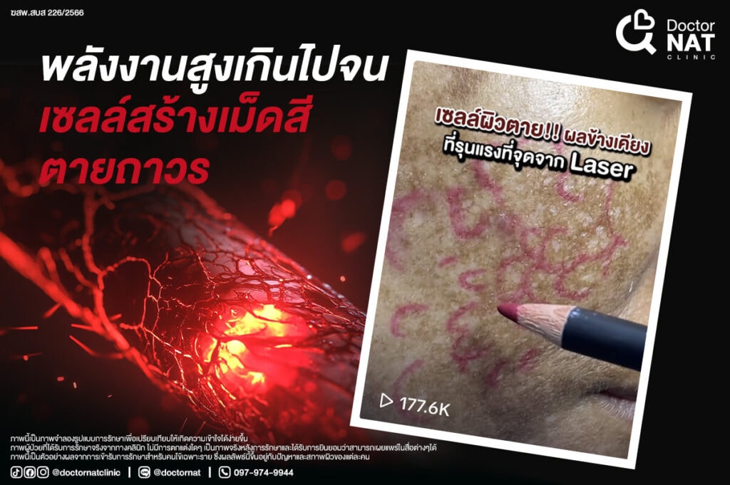 พลังงานสูงเกินไปจนเซลล์สร้างเม็ดสีตายถาวร