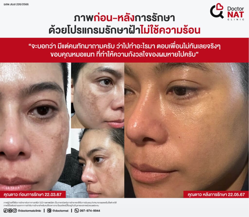 เปรียบเทียบก่อน-หลังการรักษาฝ้าที่ Doctor NAT Clinic