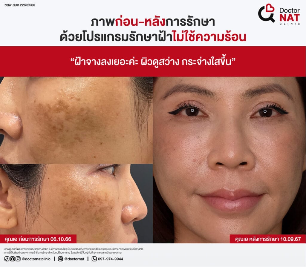 เปรียบเทียบก่อน-หลังการรักษาฝ้าที่ Doctor NAT Clinic