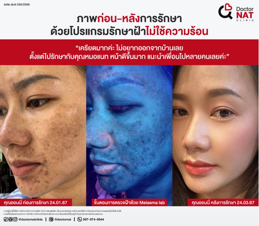 เปรียบเทียบก่อน-หลังการรักษาฝ้าที่ Doctor NAT Clinic