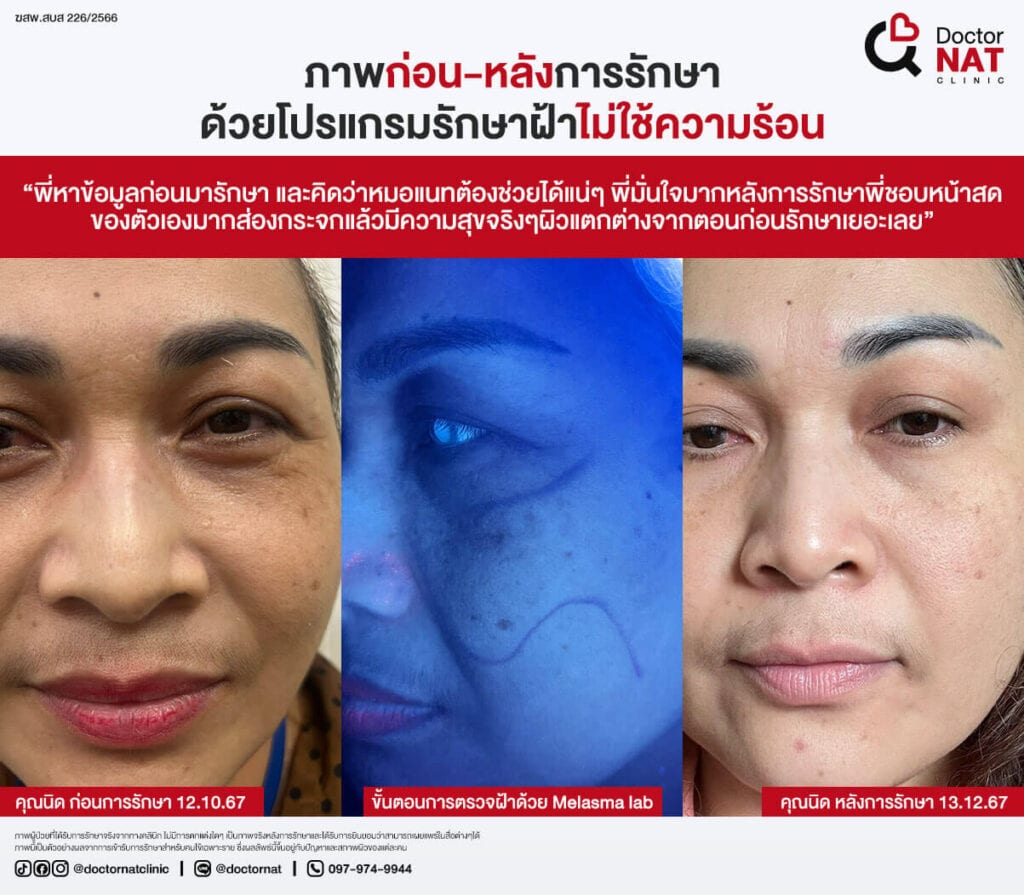 เปรียบเทียบก่อน-หลังการรักษาฝ้าที่ Doctor NAT Clinic