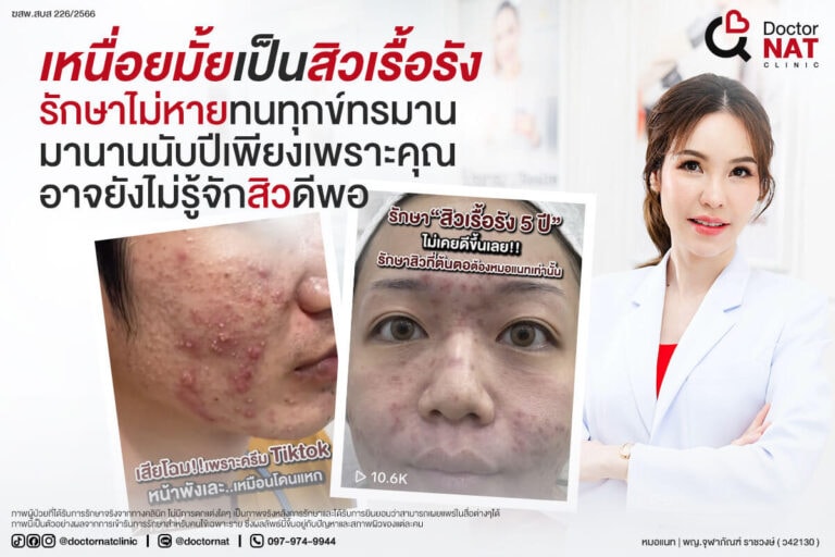 สิวเรื้อรัง