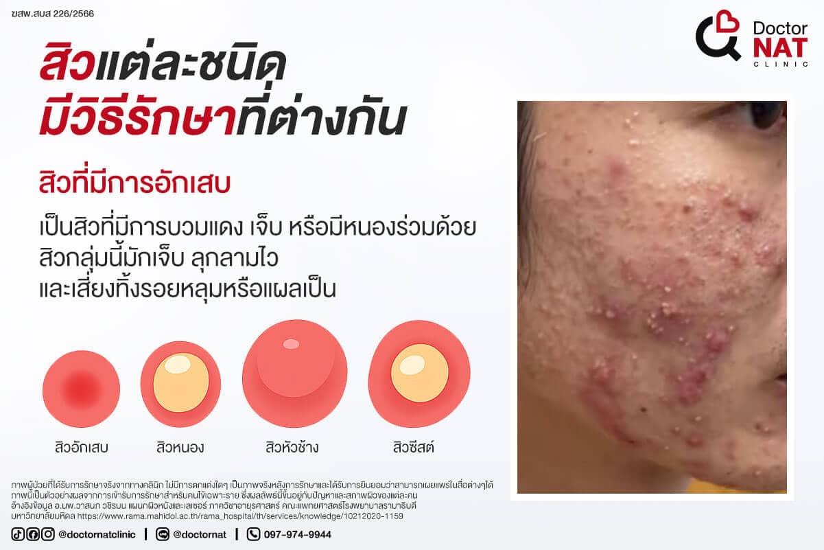 สิวแต่ละชนิด มีวิธีรักษาที่ต่างกัน