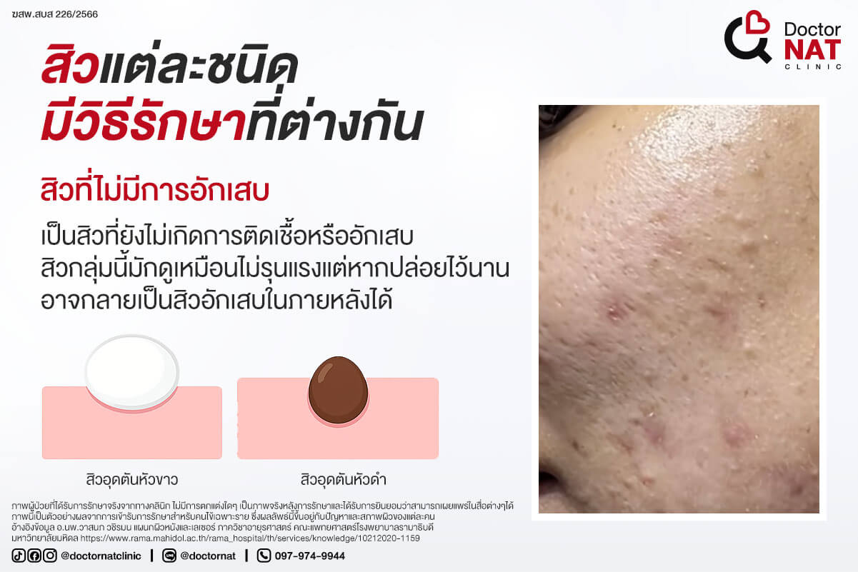 สิวแต่ละชนิด มีวิธีรักษาที่ต่างกัน