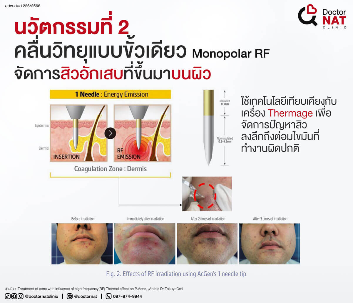 นวัตกรรมที่ 2 
คลื่นวิทยุแบบขั้วเดียว Monopolar RF
จัดการสิวอักเสบที่ขึ้นมาบนผิว