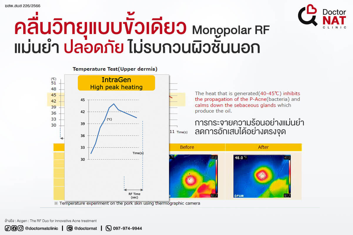ทำไมคลื่นวิทยุแบบขั้วเดียว ถึงเหมาะกับการรักษาสิว?