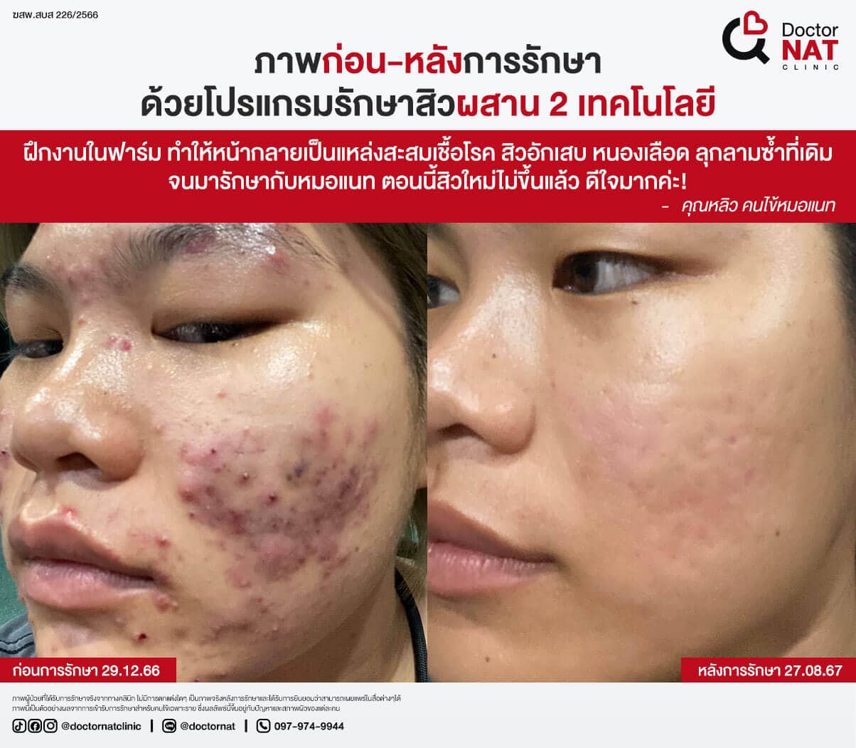 ภาพก่อน-หลังการรักษาสิวที่ DoctorNAT Clinic