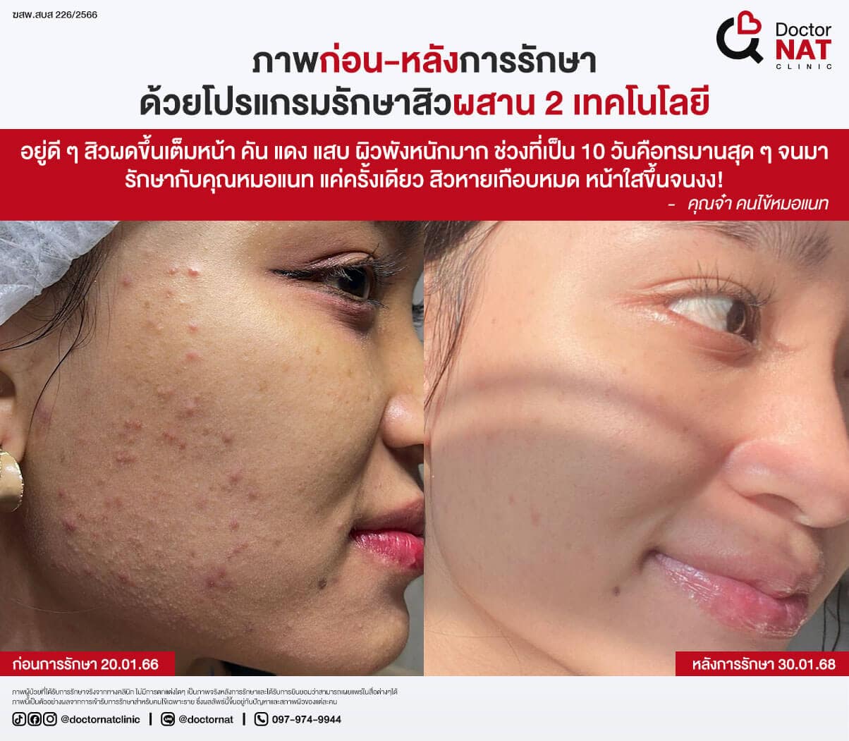 ภาพก่อน-หลังการรักษาสิวที่ DoctorNAT Clinic