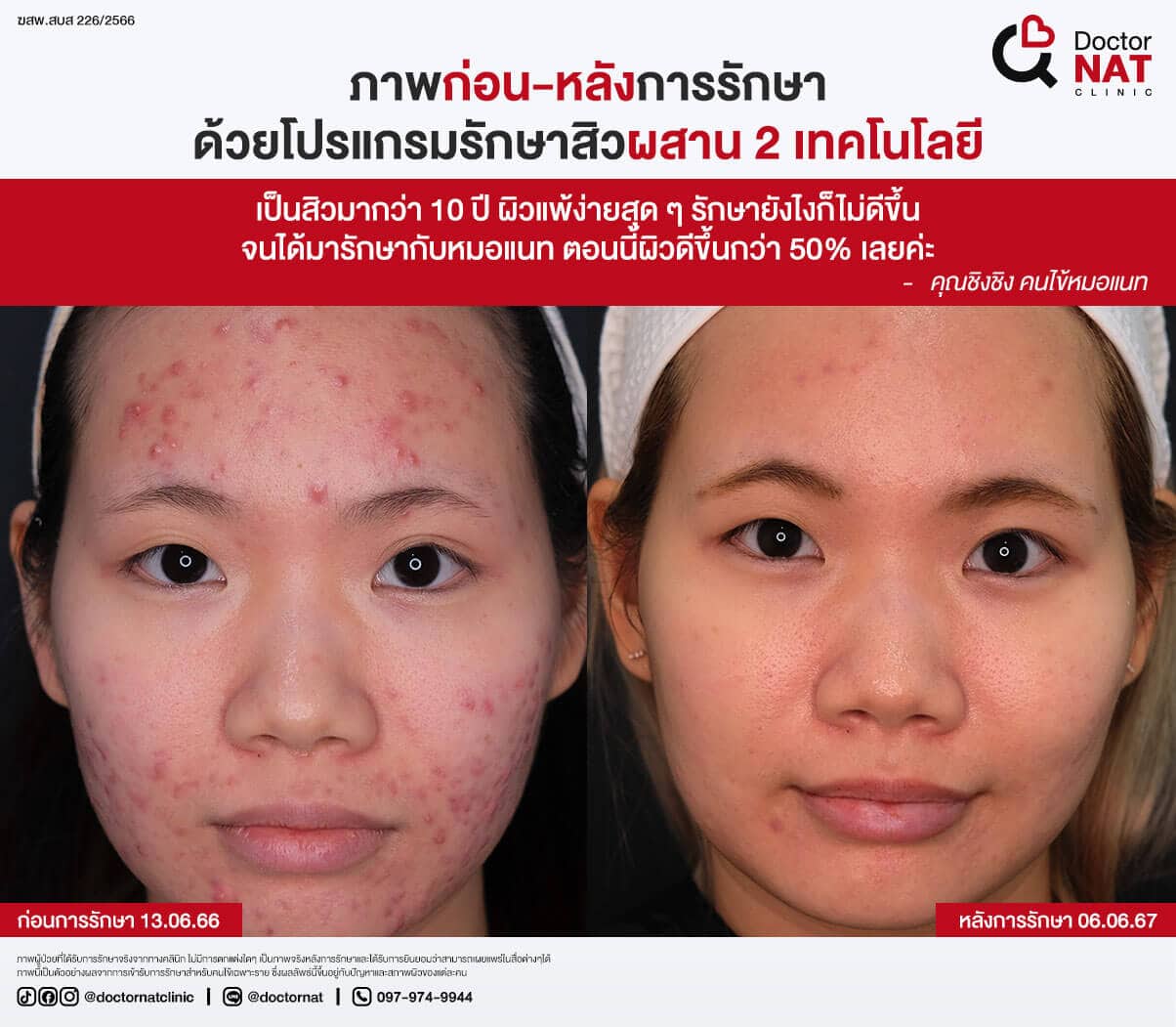 ภาพก่อน-หลังการรักษาสิวที่ DoctorNAT Clinic