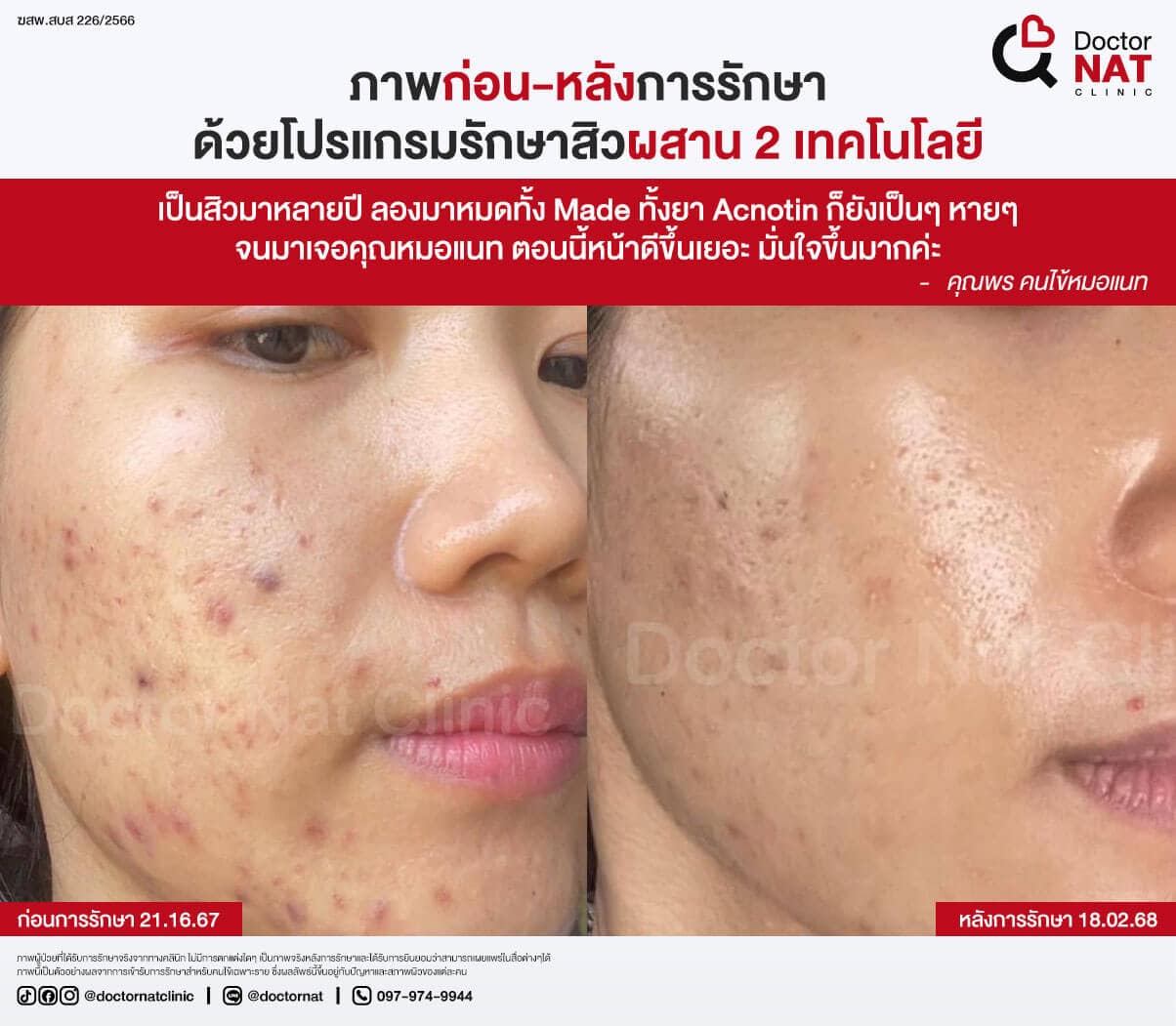 ภาพก่อน-หลังการรักษาสิวที่ DoctorNAT Clinic