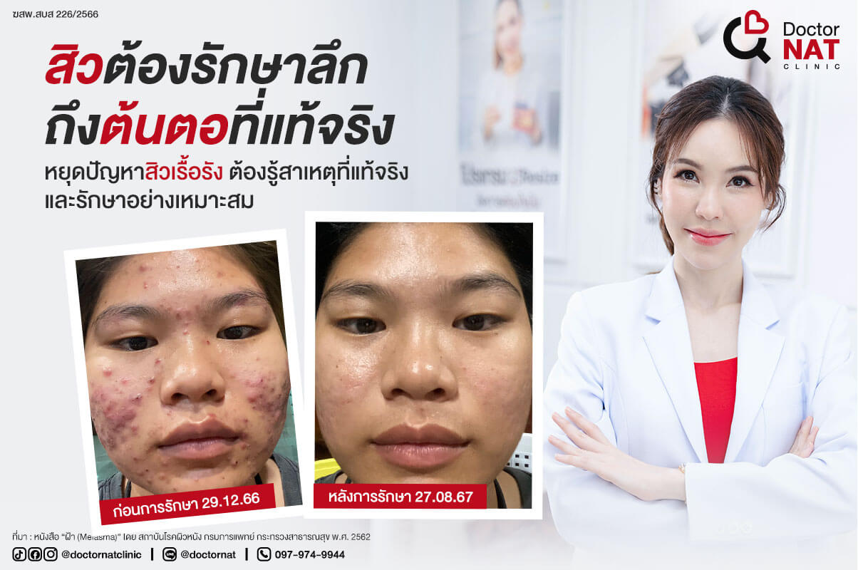 ทำไมต้องรักษาสิวที่ Doctor NAT Clinic