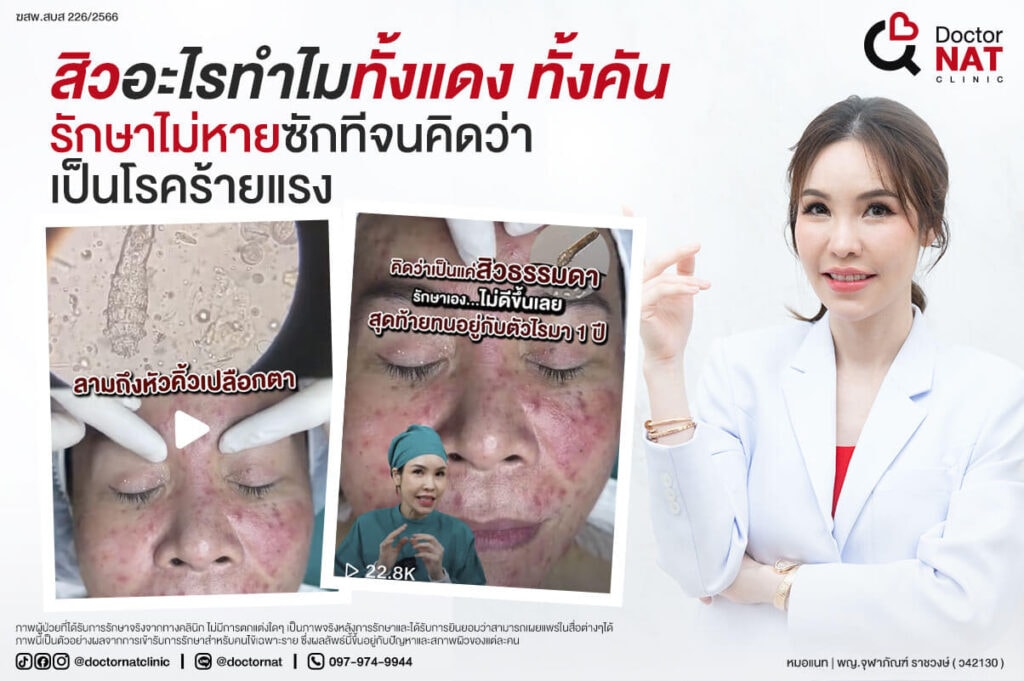 หน้าแรก 21 เคยสงสัยไหม...ว่าทำไมสิวคุณทั้งคัน ทั้งแดง เห่อไปหมดทั้งหน้า รักษาเท่าไหร่ก็ไม่ดีขึ้นเลย