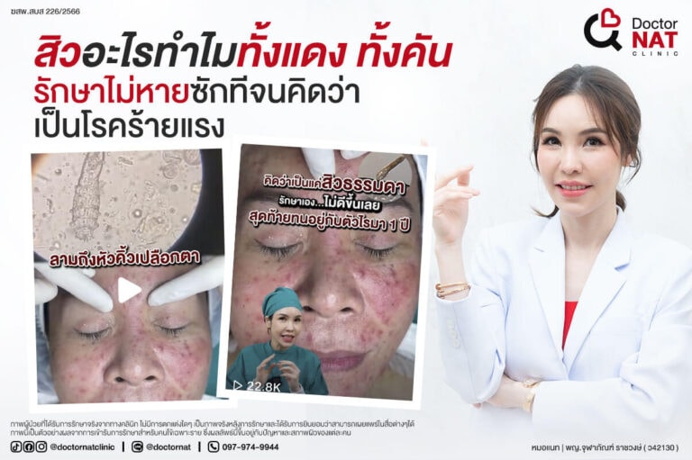 เคยสงสัยไหม...ว่าทำไมสิวคุณทั้งคัน ทั้งแดง เห่อไปหมดทั้งหน้า รักษาเท่าไหร่ก็ไม่ดีขึ้นเลย