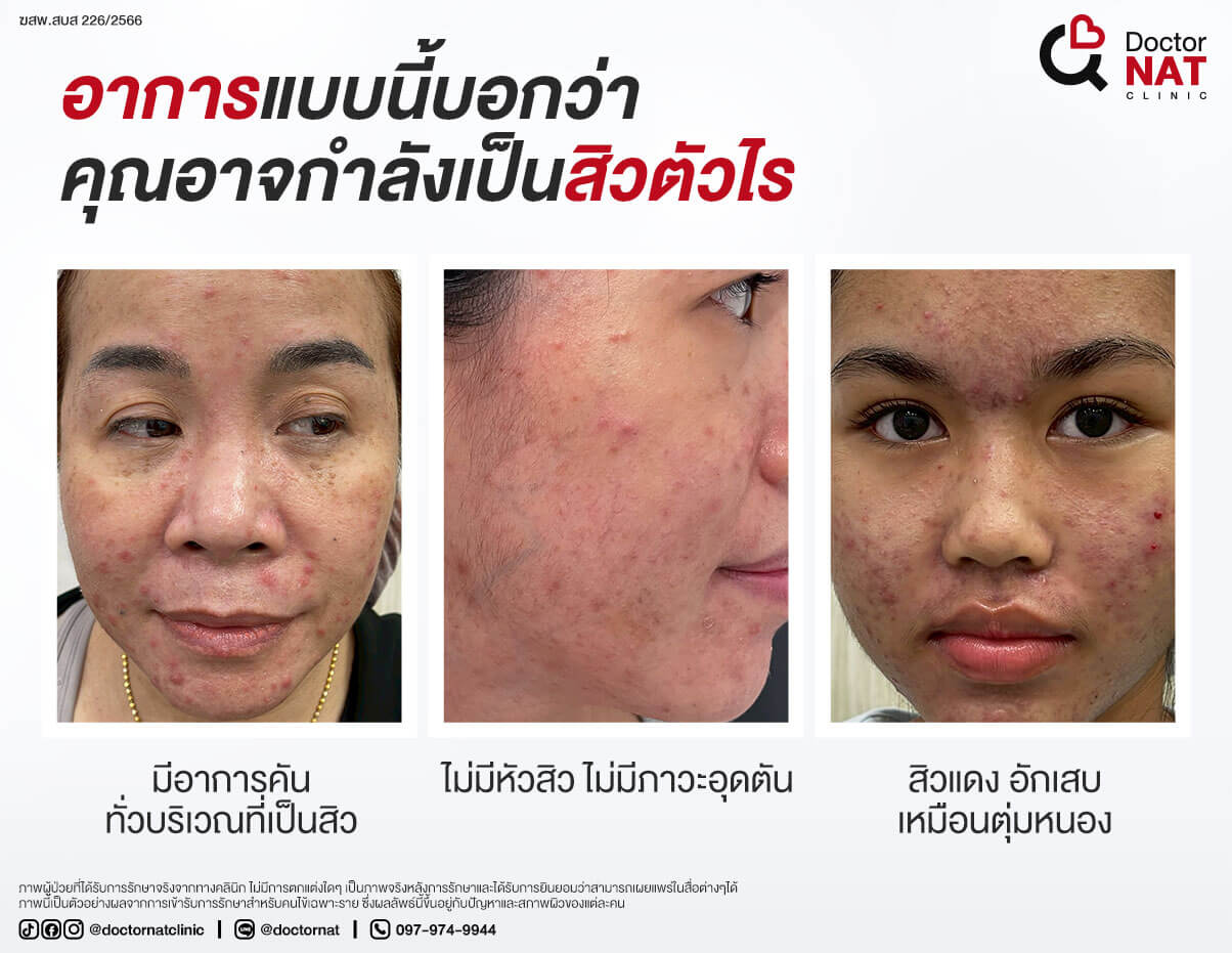 อาการของสิวตัวไร