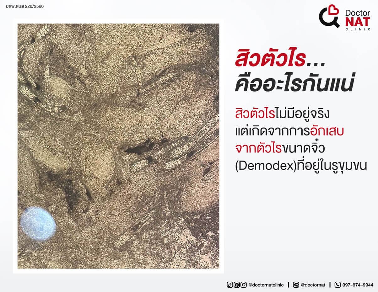 สิวตัวไร คืออะไร
