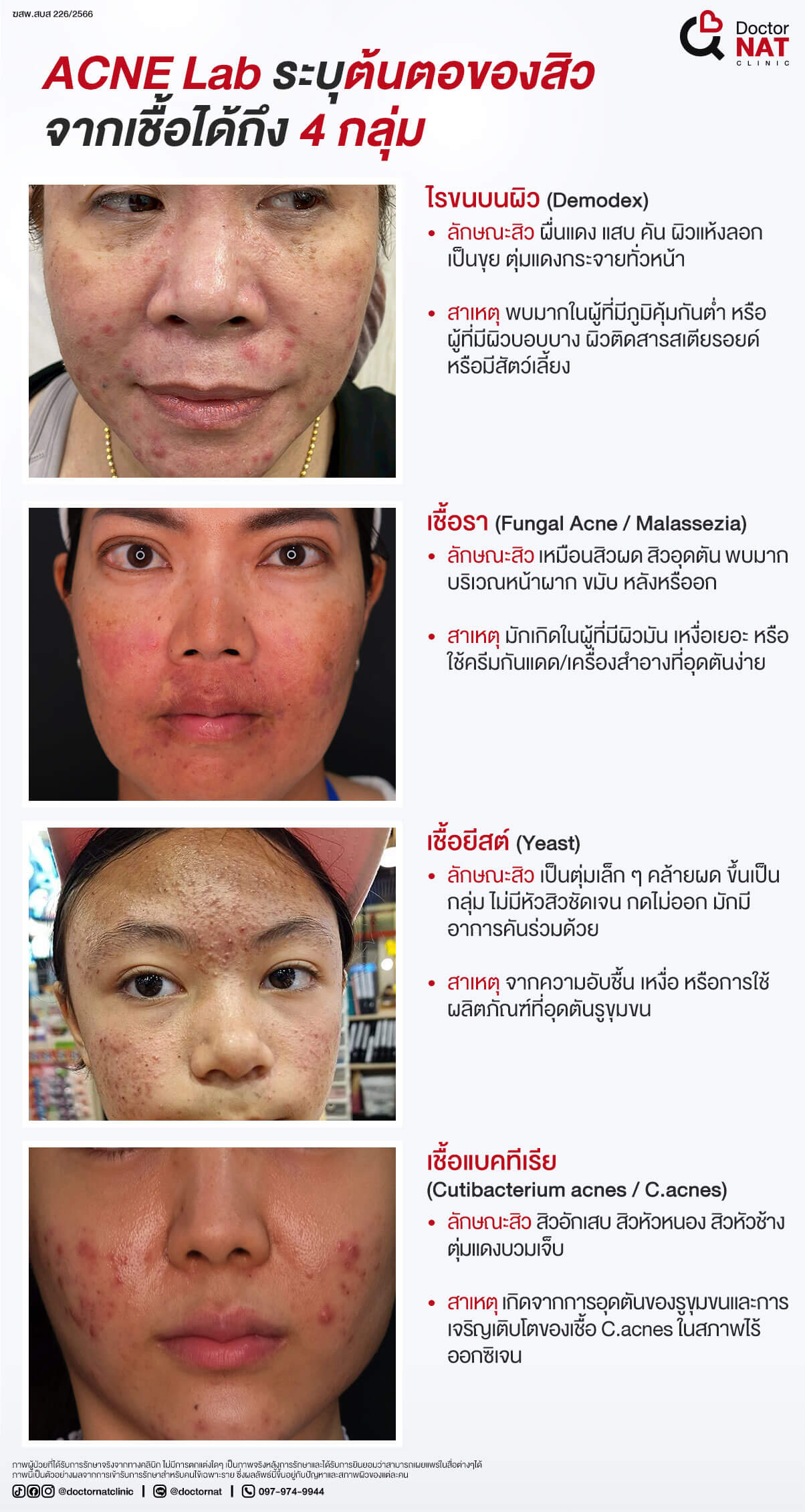 ACNE Lab ระบุต้นตอของสิวจากเชื้อได้ถึง 4 กลุ่ม
