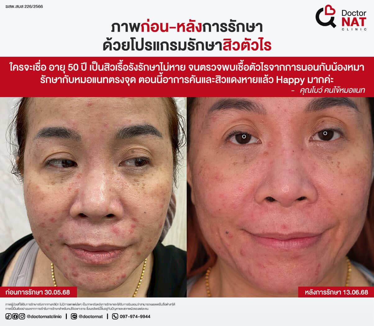 ภาพก่อน-หลังการรักษาสิวตัวไร Doctor NAT Clinic