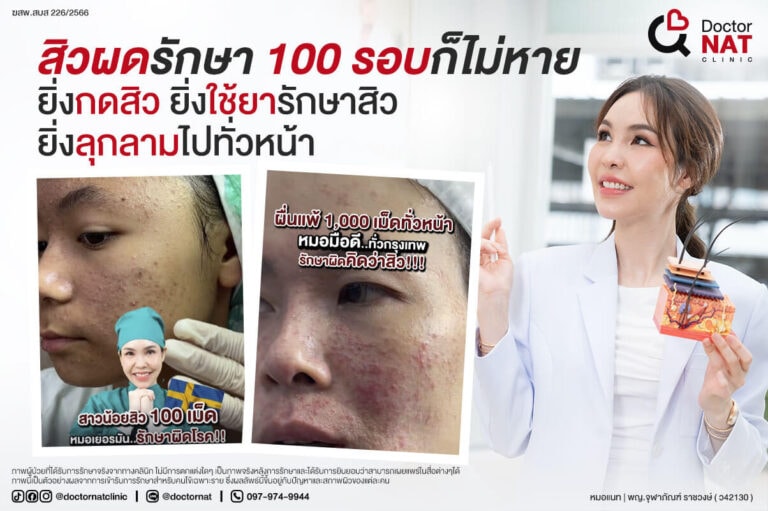 สิวผด สิวประหลาด ยิ่งรักษา ยิ่งลุกลาม