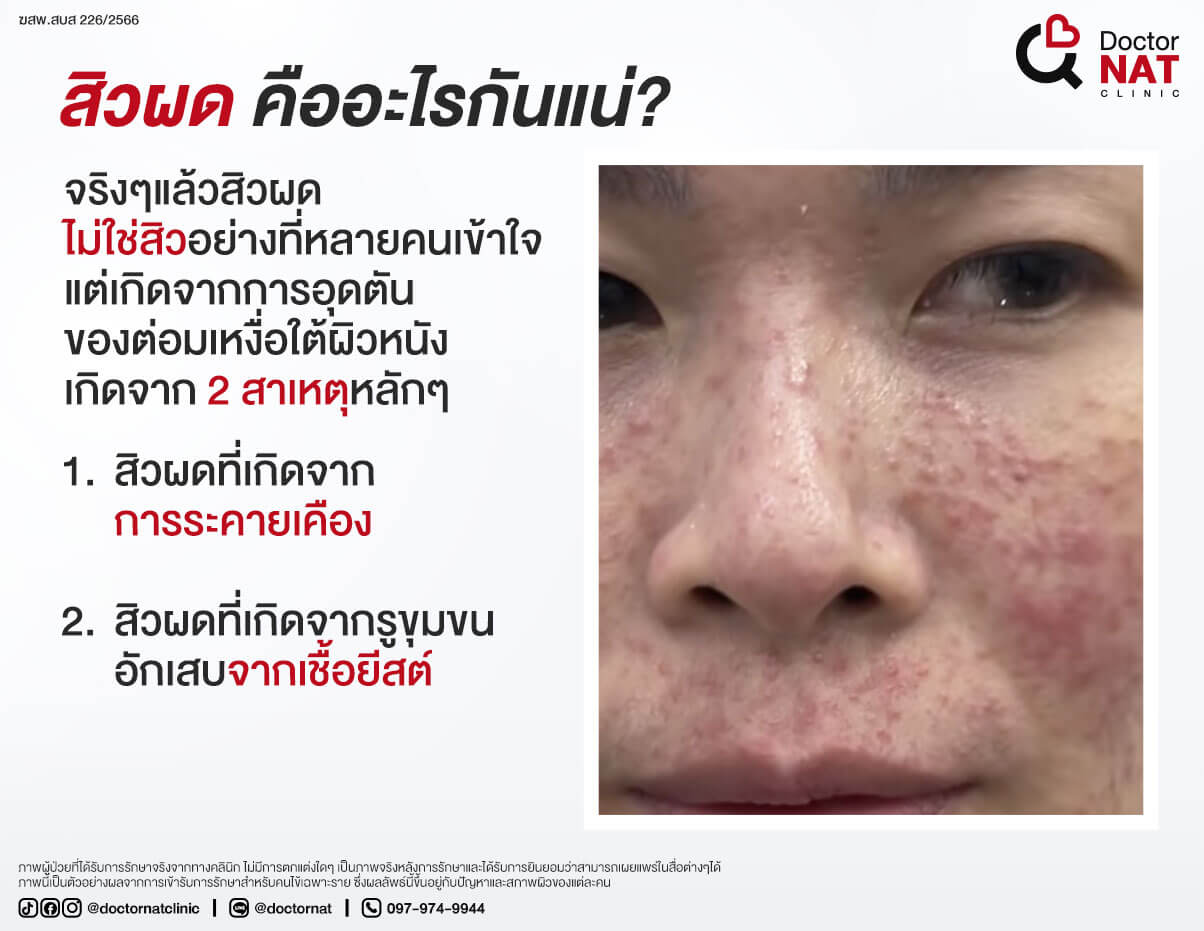 สิวผด...คืออะไรกันแน่