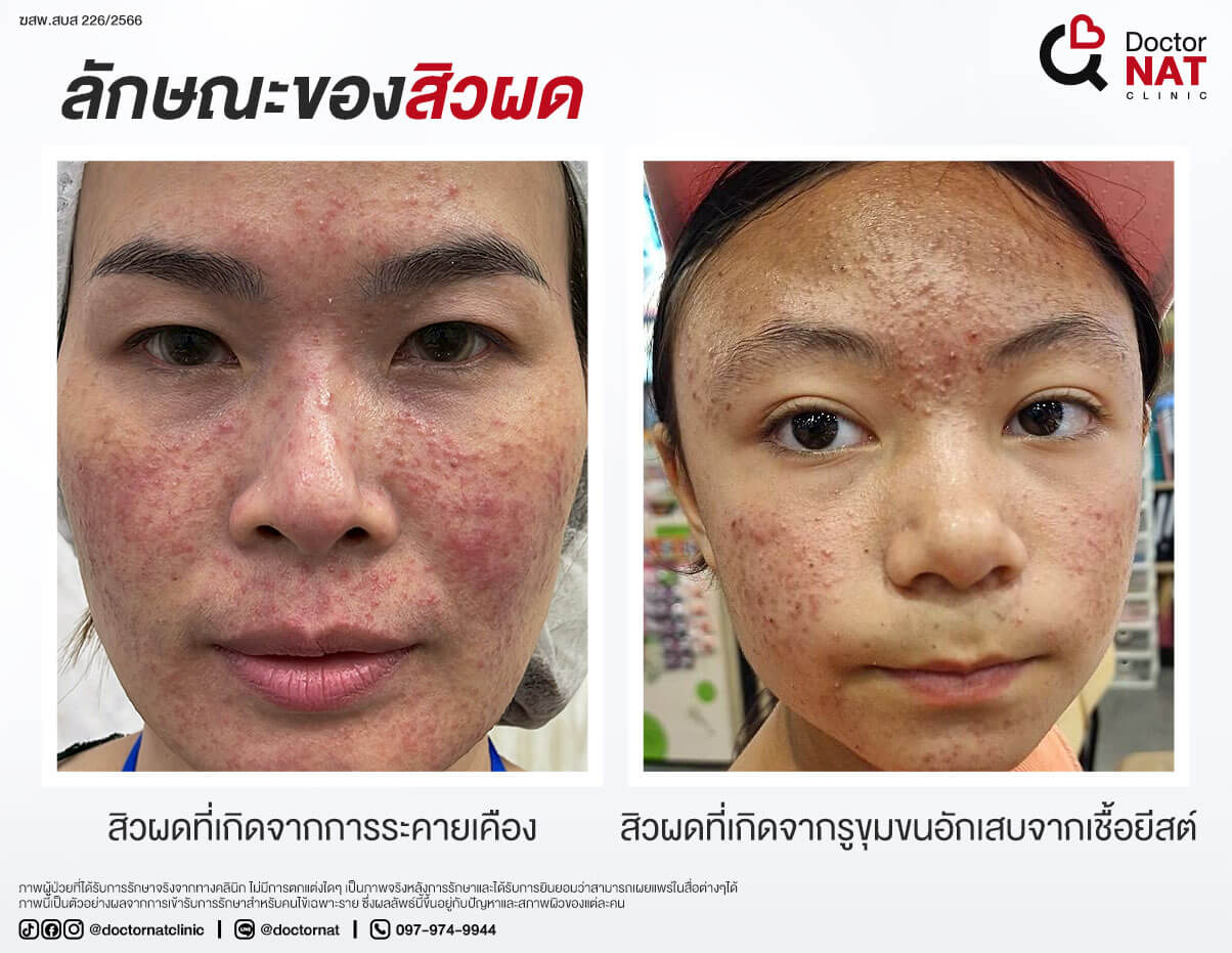 ลักษณะเด่นของสิวผดที่หลายคนมองข้าม