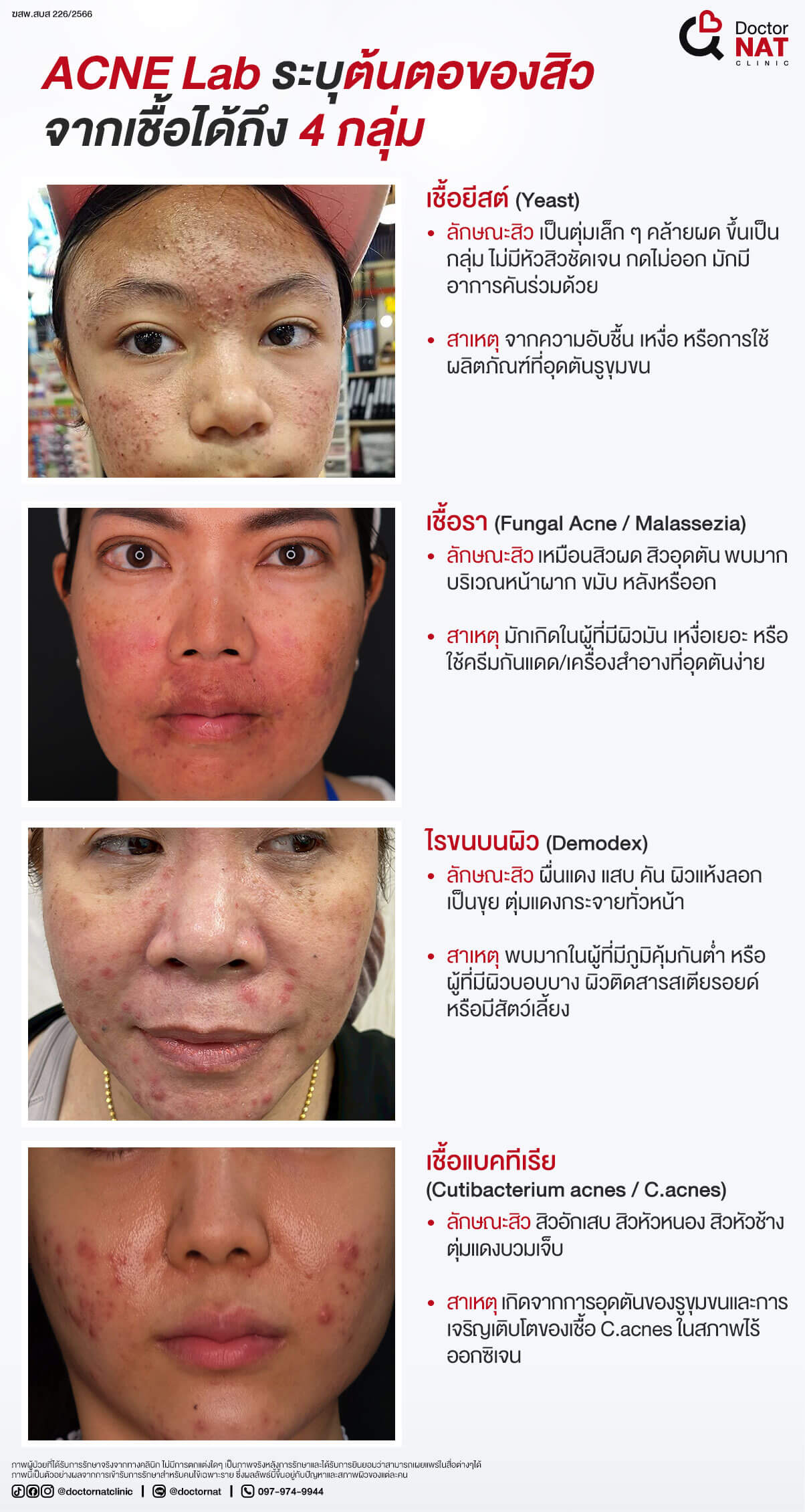 ACNE Lab ระบุต้นตอของสิวจากเชื้อได้ถึง 4 กลุ่ม
