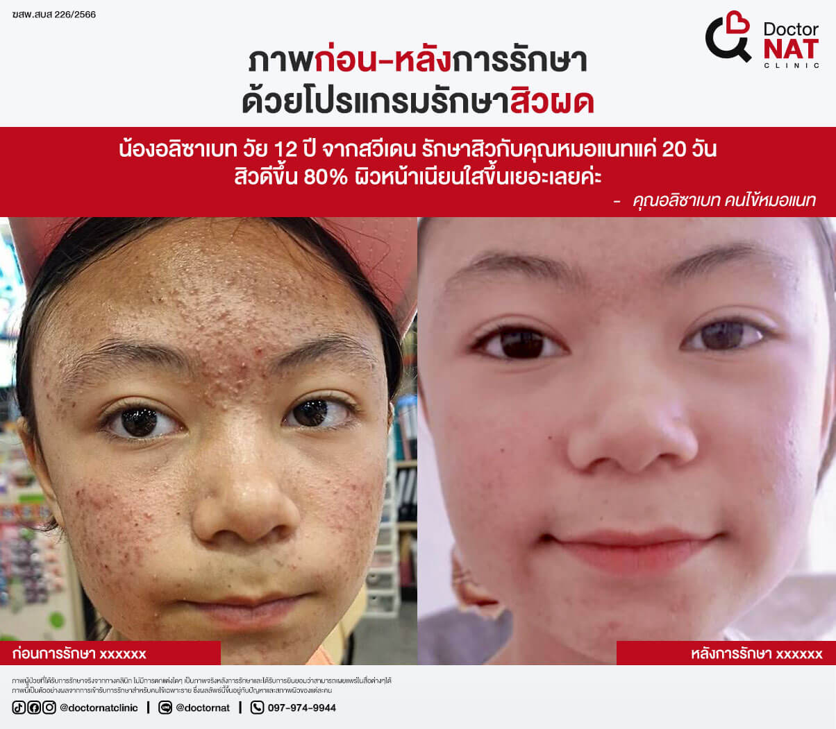 ภาพก่อน-หลังการรักษาสิวผด Doctor NAT Clinic
