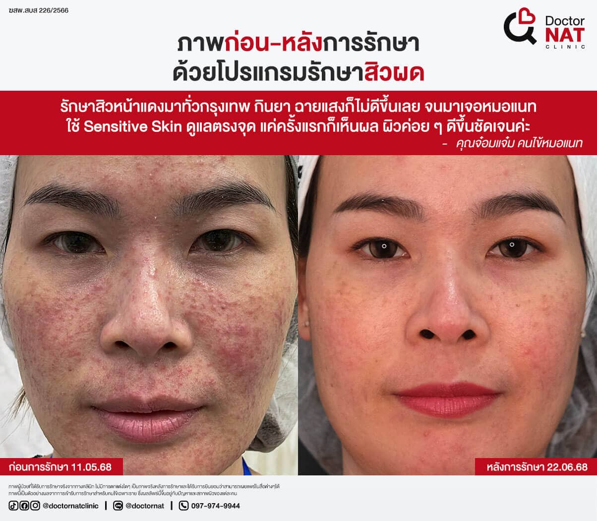 ภาพก่อน-หลังการรักษาสิวผด Doctor NAT Clinic