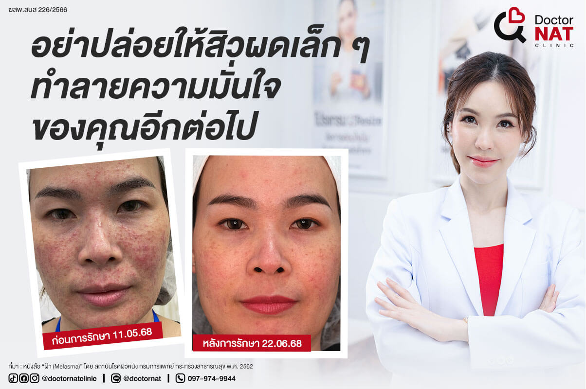ทำไมต้องรักษาสิวผดที่ Doctor NAT Clinic