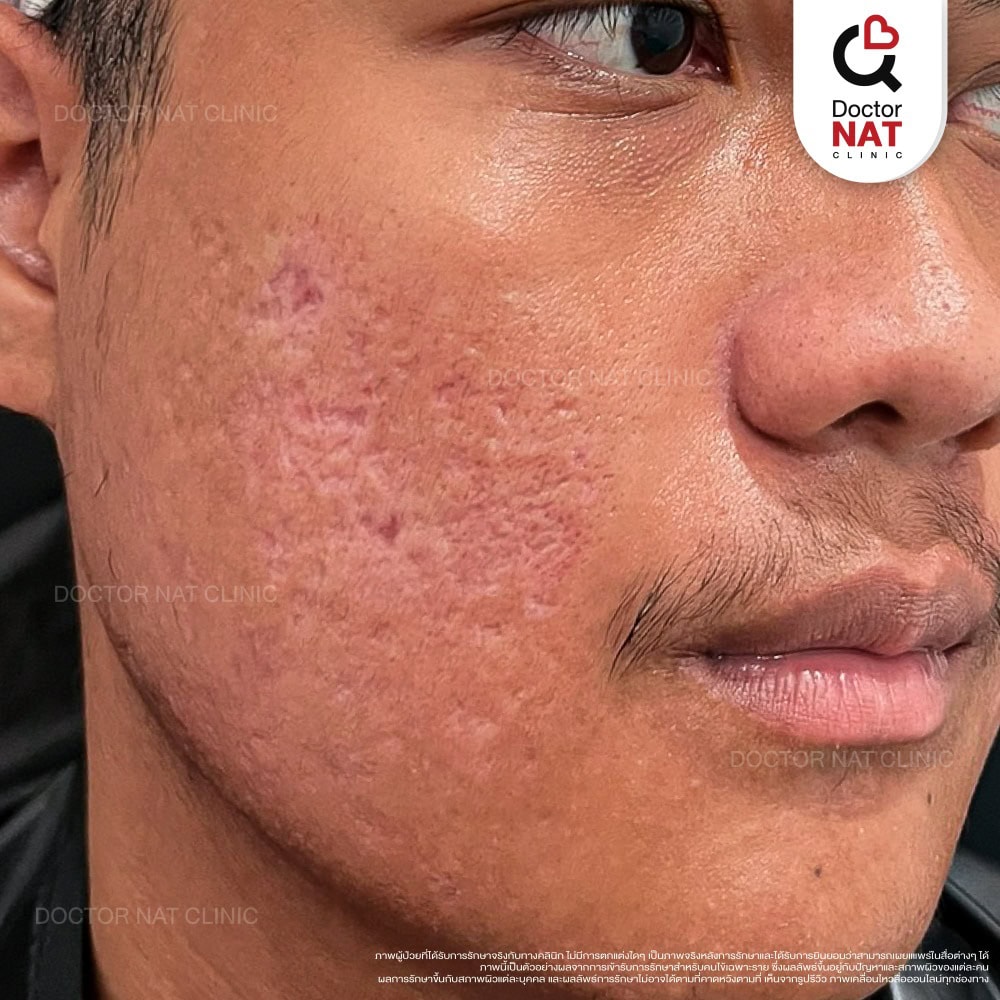 ผู้ชายที่เป็นหลุมสิวก่อนการรักษาด้วยโปรแกรม MASS Surgery