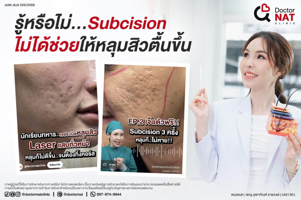 รักษาหลุมสิว MASS Advanced Doctor NAT Clinic