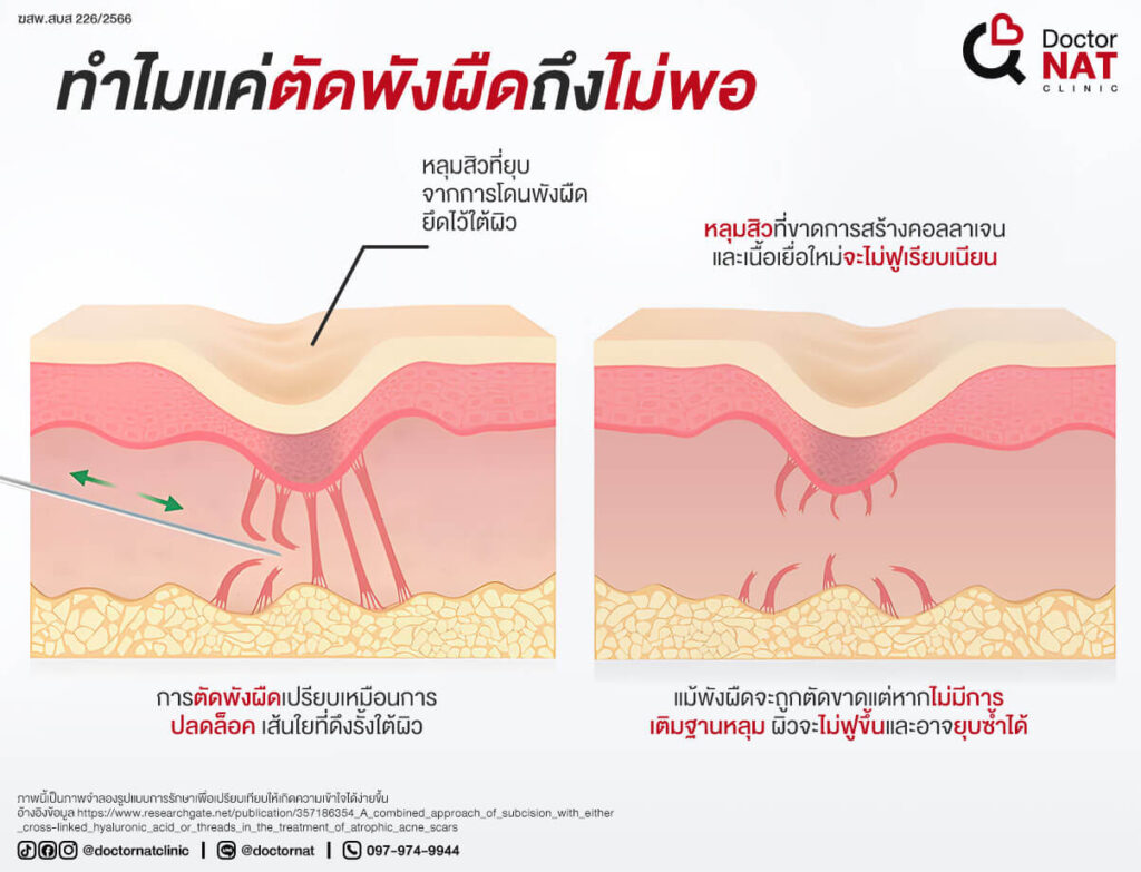 ทำไมแค่ตัดพังผืดถึงไม่พอ