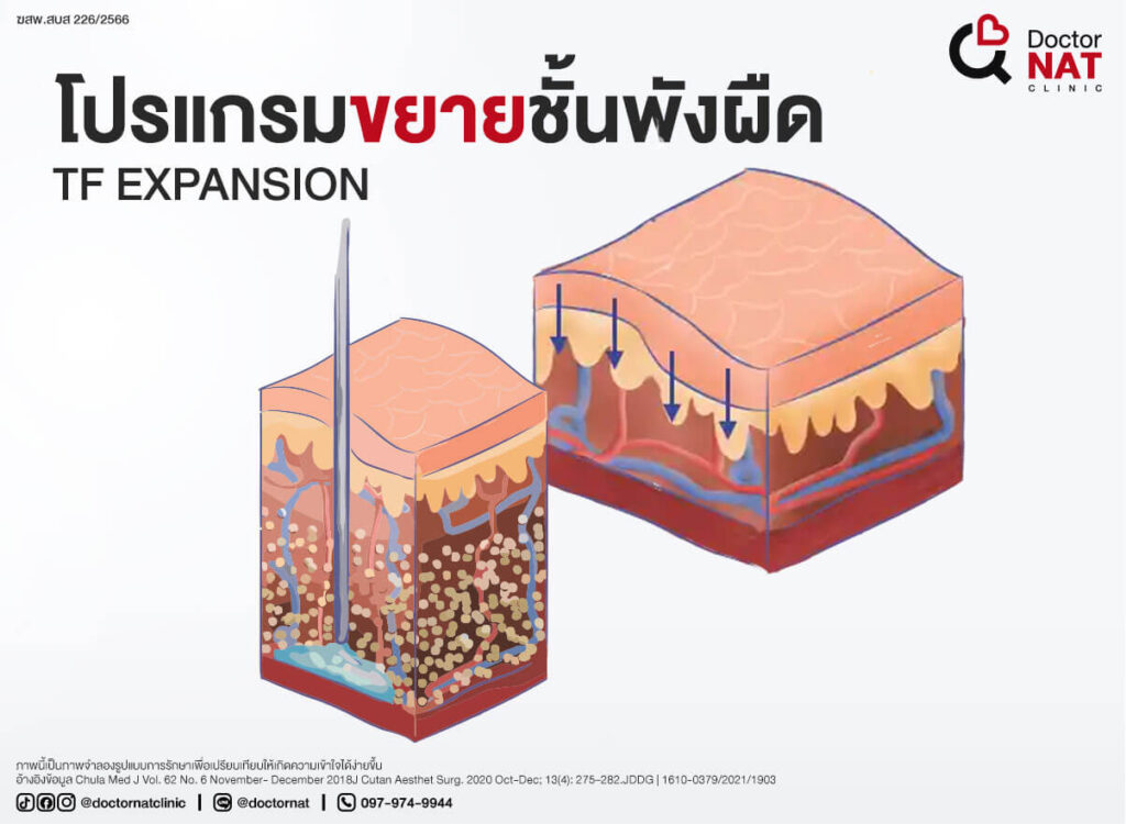 โปรแกรม ขยายชั้นพังผืดหลุมสิว Doctor NAT Clinic