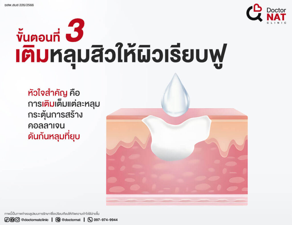 ขั้นตอนที่ 3 
เติมหลุมสิวให้ผิวเรียบฟู