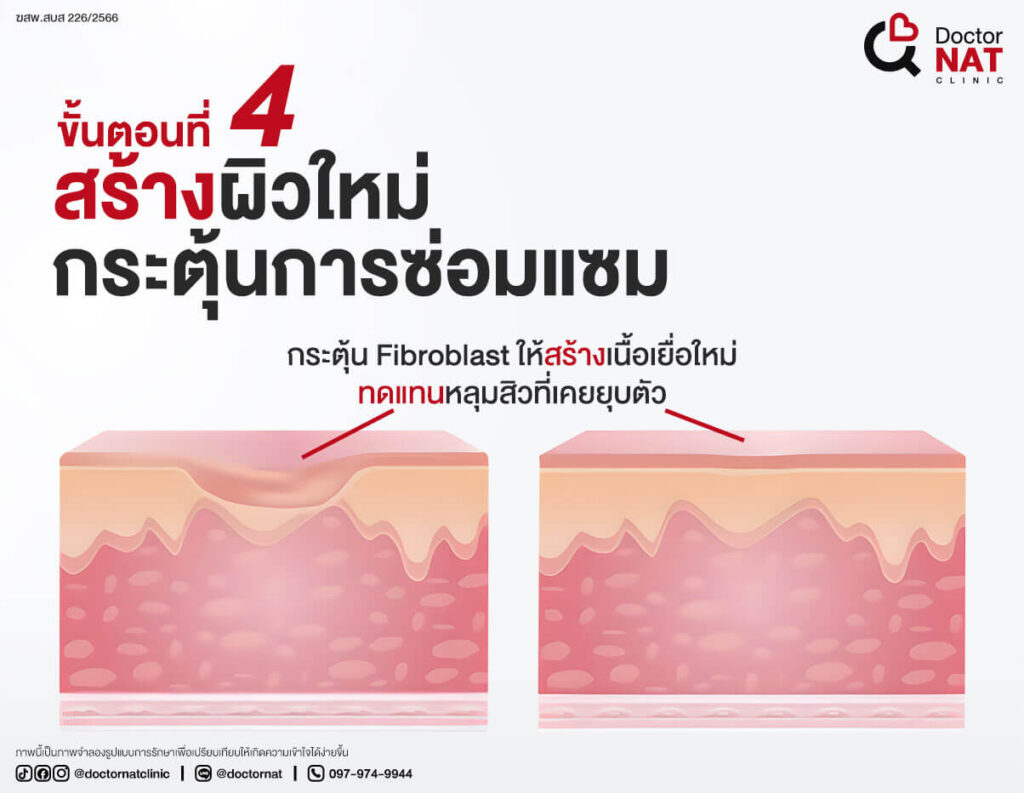 ขั้นตอนที่ 4 
สร้างผิวใหม่กระตุ้นการซ่อมแซม
