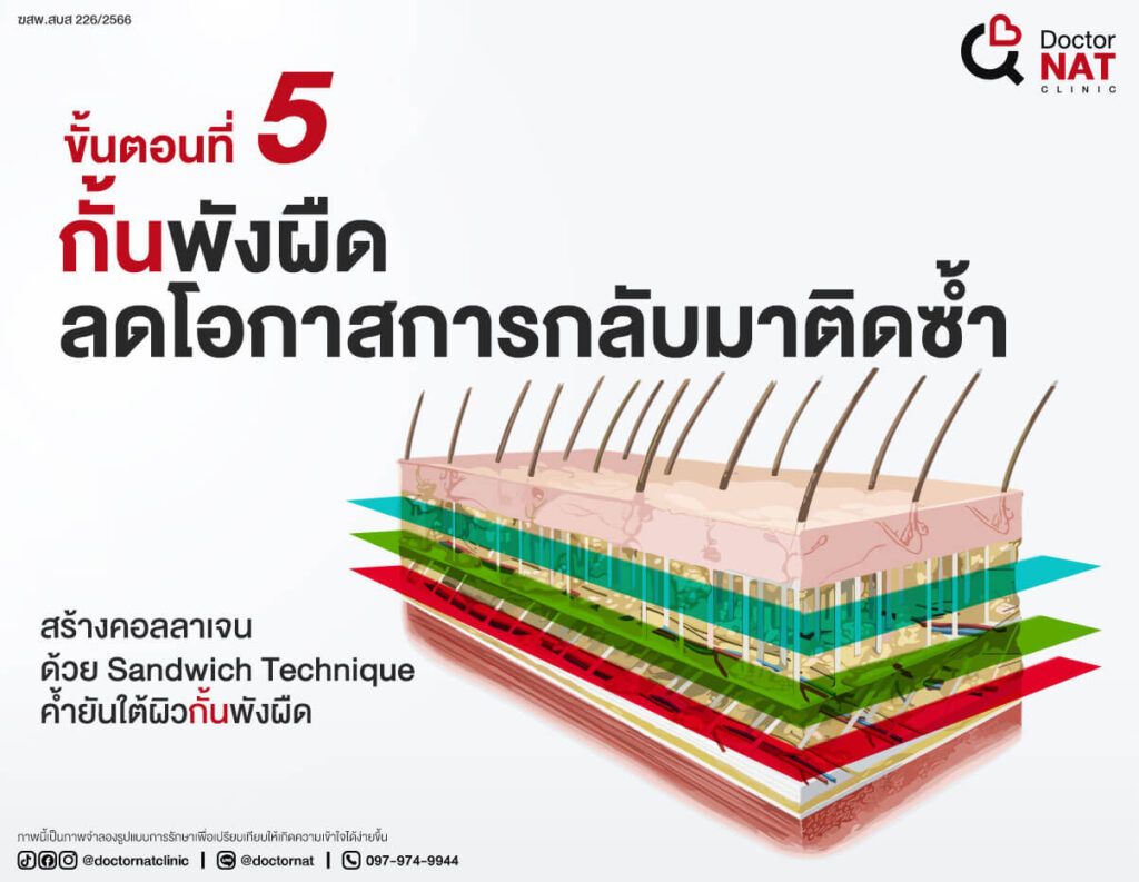 ขั้นตอนที่ 5 
กั้นพังผืดลดโอกาสการกลับมาติดซ้ำ