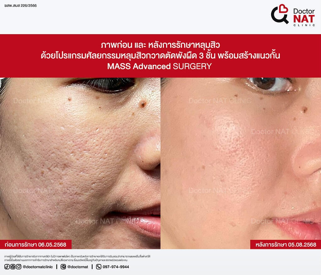 ภาพก่อน และ หลังการรักษาหลุมสิว MASS Advanced Doctor NAT Clinic