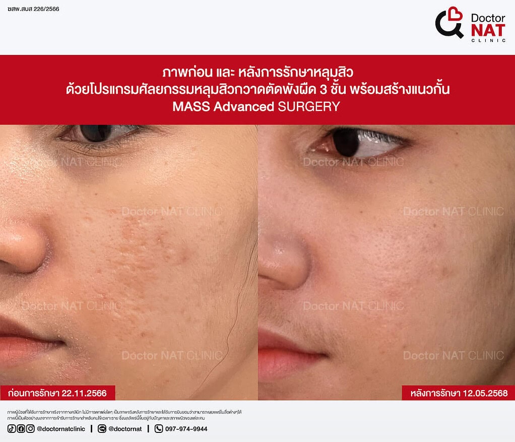 ภาพก่อน และ หลังการรักษาหลุมสิว MASS Advanced Doctor NAT Clinic