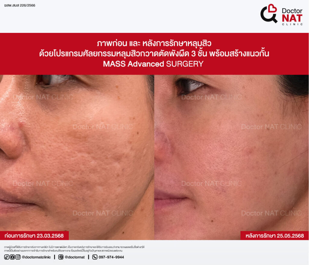 ภาพก่อน และ หลังการรักษาหลุมสิว MASS Advanced Doctor NAT Clinic