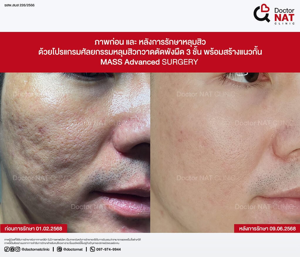 ภาพก่อน และ หลังการรักษาหลุมสิว MASS Advanced Doctor NAT Clinic